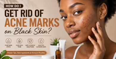 How Do I Get Rid of Acne Marks on Black Skin